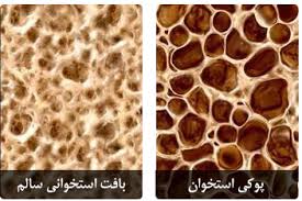 نقش تغذيه در پيشگيري از پوكي استخوان